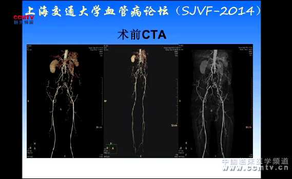 陆信武：双侧髂总髂外动脉闭塞 球囊扩张支架植入术（含讲解）